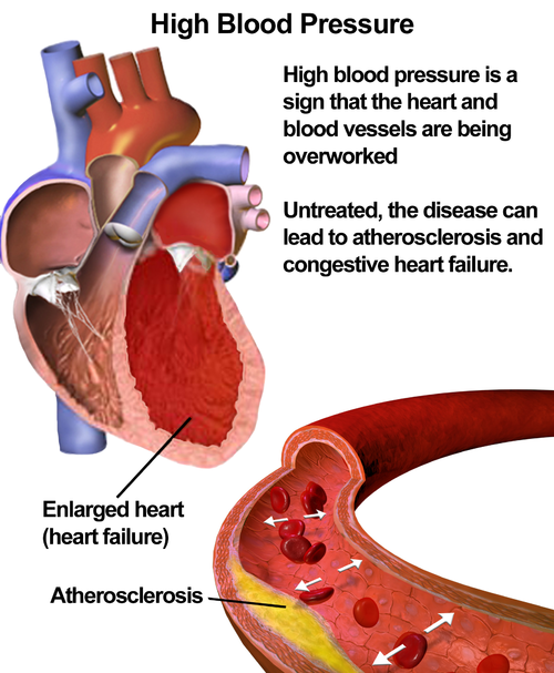 Cardiovascular Diseases