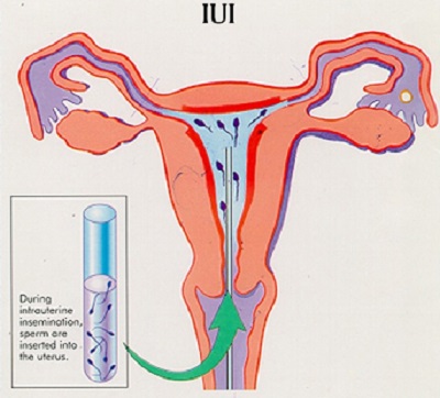 IUI Treatment